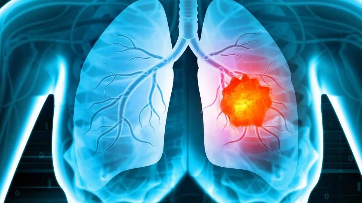 Nuove prospettive nel trattamento del cancro al polmone